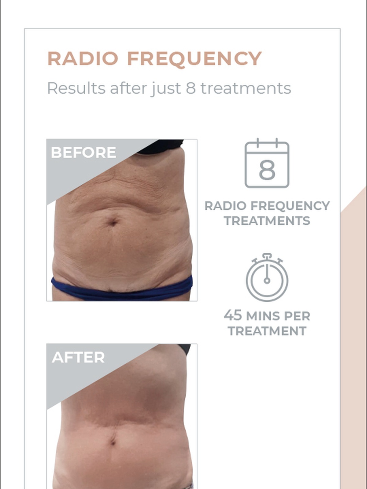3D Lipo radio frequency before and after treatment example