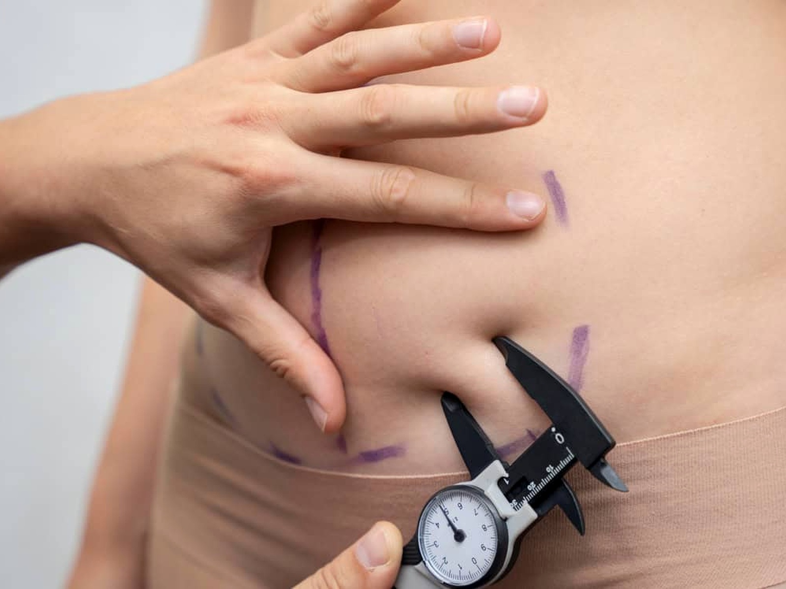 Body contouring treatment areas being measured and marked