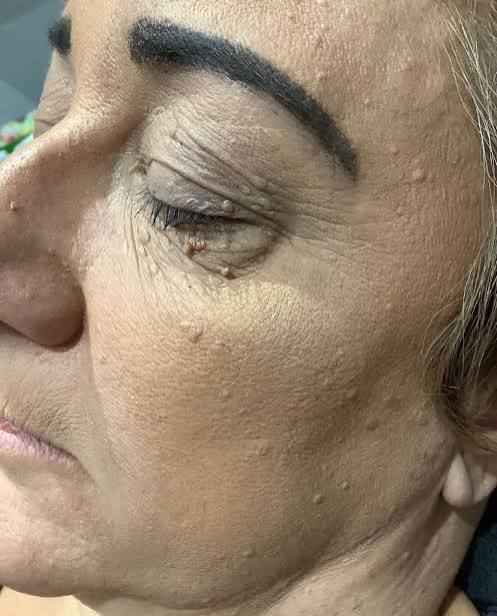 After ACCOR plasma treatment around the upper eyelid