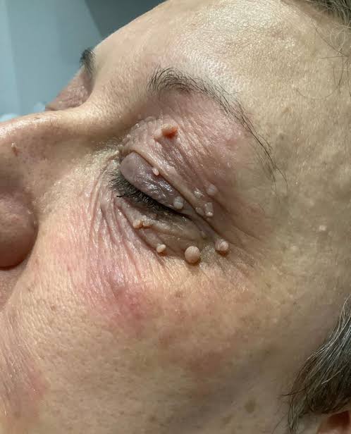 Before ACCOR plasma treatment around the upper eyelid