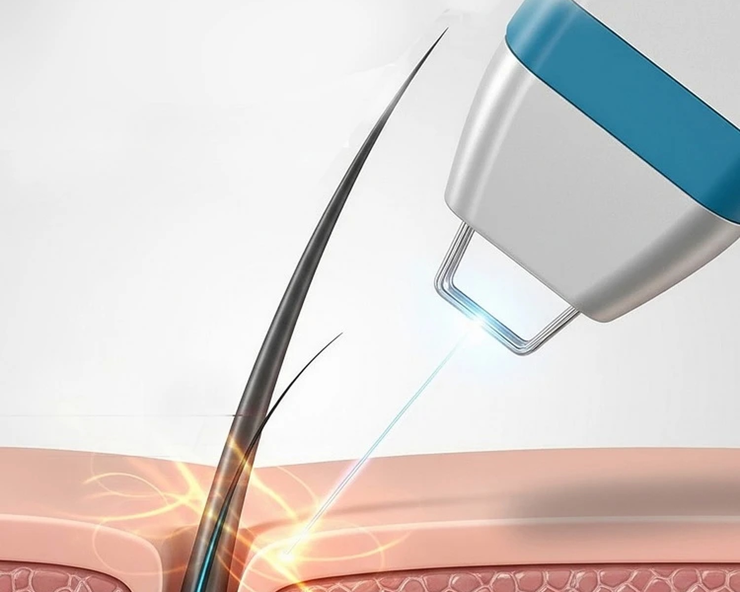 Diagram showing diode laser energy targeting a hair follicle