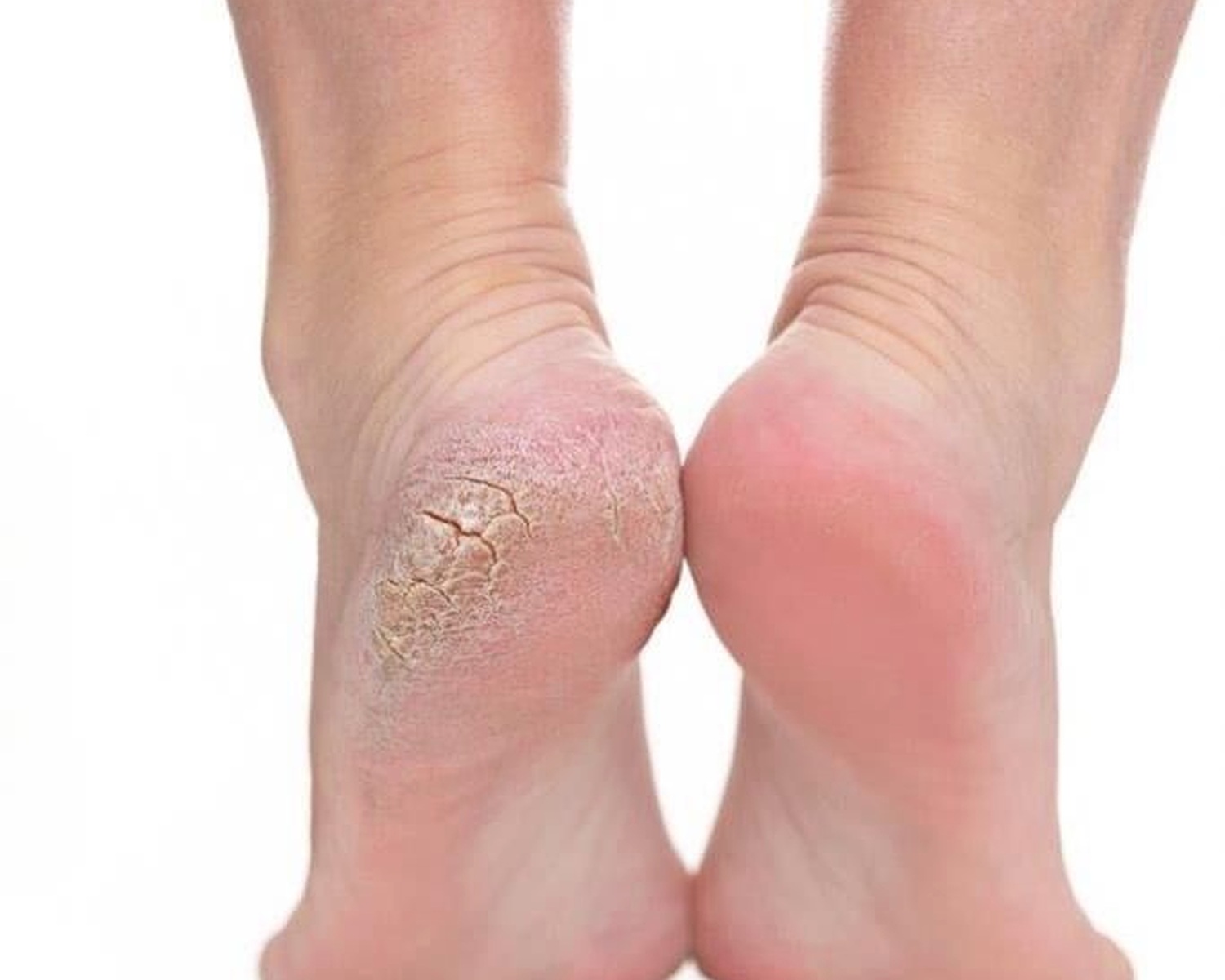 Comparison of dry cracked heel and smoother cared-for heel